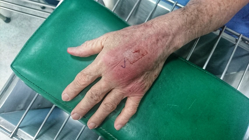 Elderly hand infected with cat bite